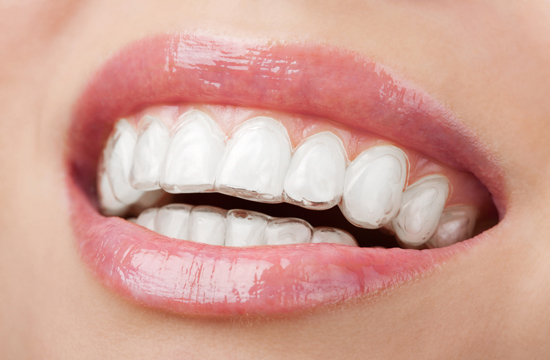 Orthodontic Care - Carlingford Dental