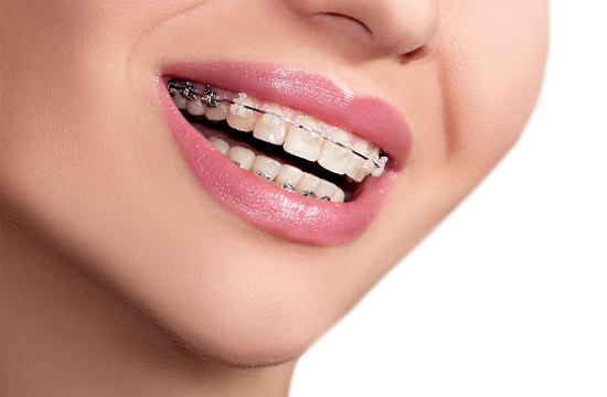 Orthodontic Care - Carlingford Dental