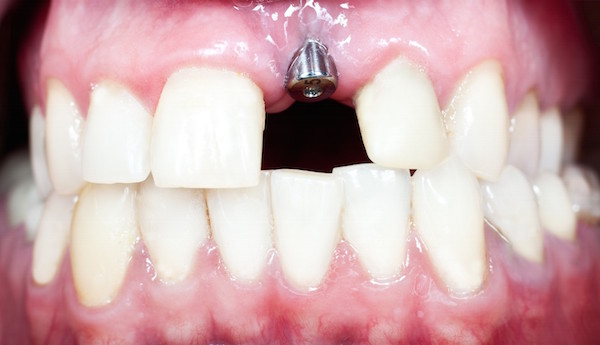 Dental Implants - Carlingford Dental