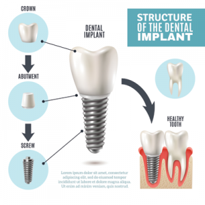 Implants