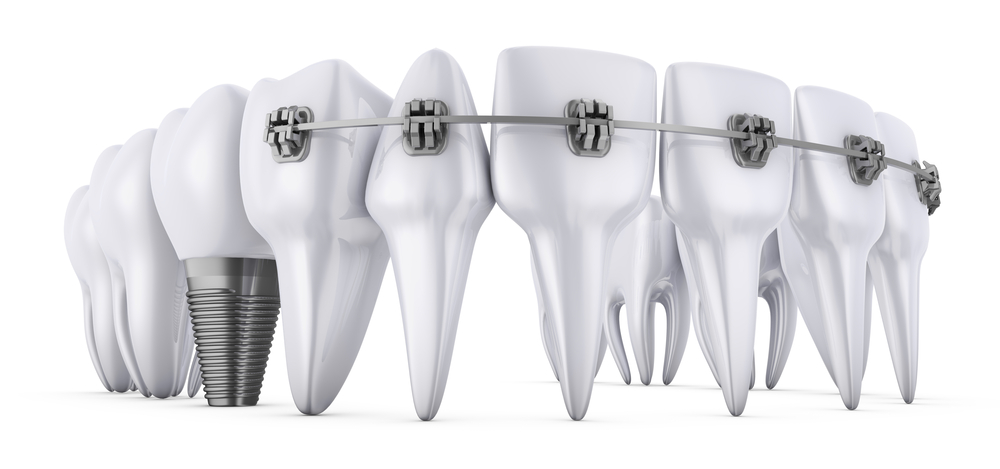 Dental Carlingford Braces