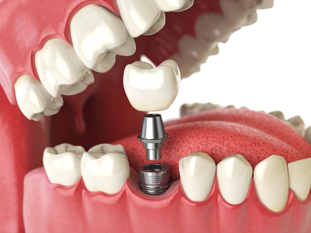 Carlingford Dental Implant Carlingford Dentist