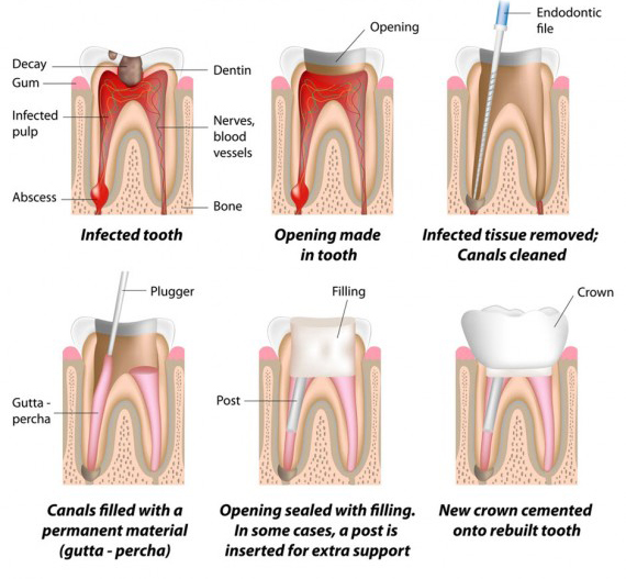 Root Canal Therapy - Carlingford Dentist