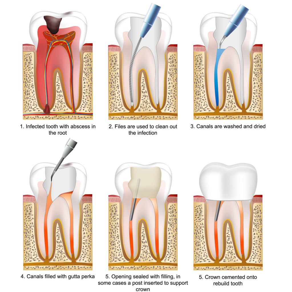 rootcanal