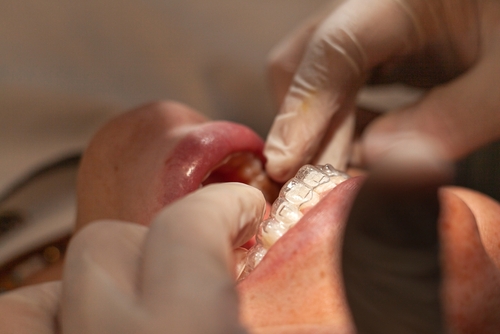 Close-up,Of,An,Orthodontic,Specialist,Adjusting,And,Placing,Invisible,Aligners