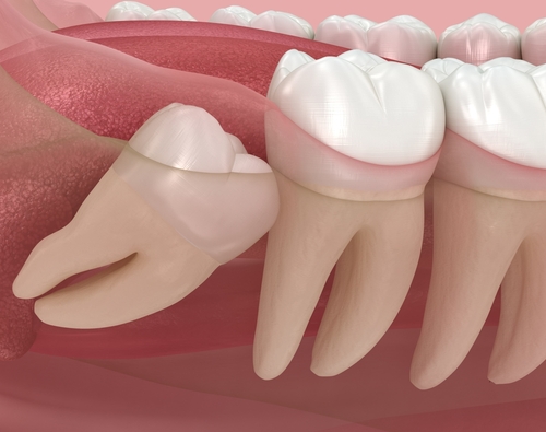 Abnormal,Position,Of,Wisdom,Teeth.,Medically,Accurate,Tooth,3d,Illustration