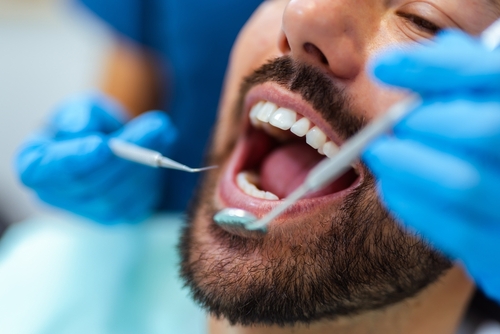 Close-up,Of,A,Man,With,Open,Mouth,During,Dental,Checkup